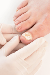 Keryflex for Toenail Fungus